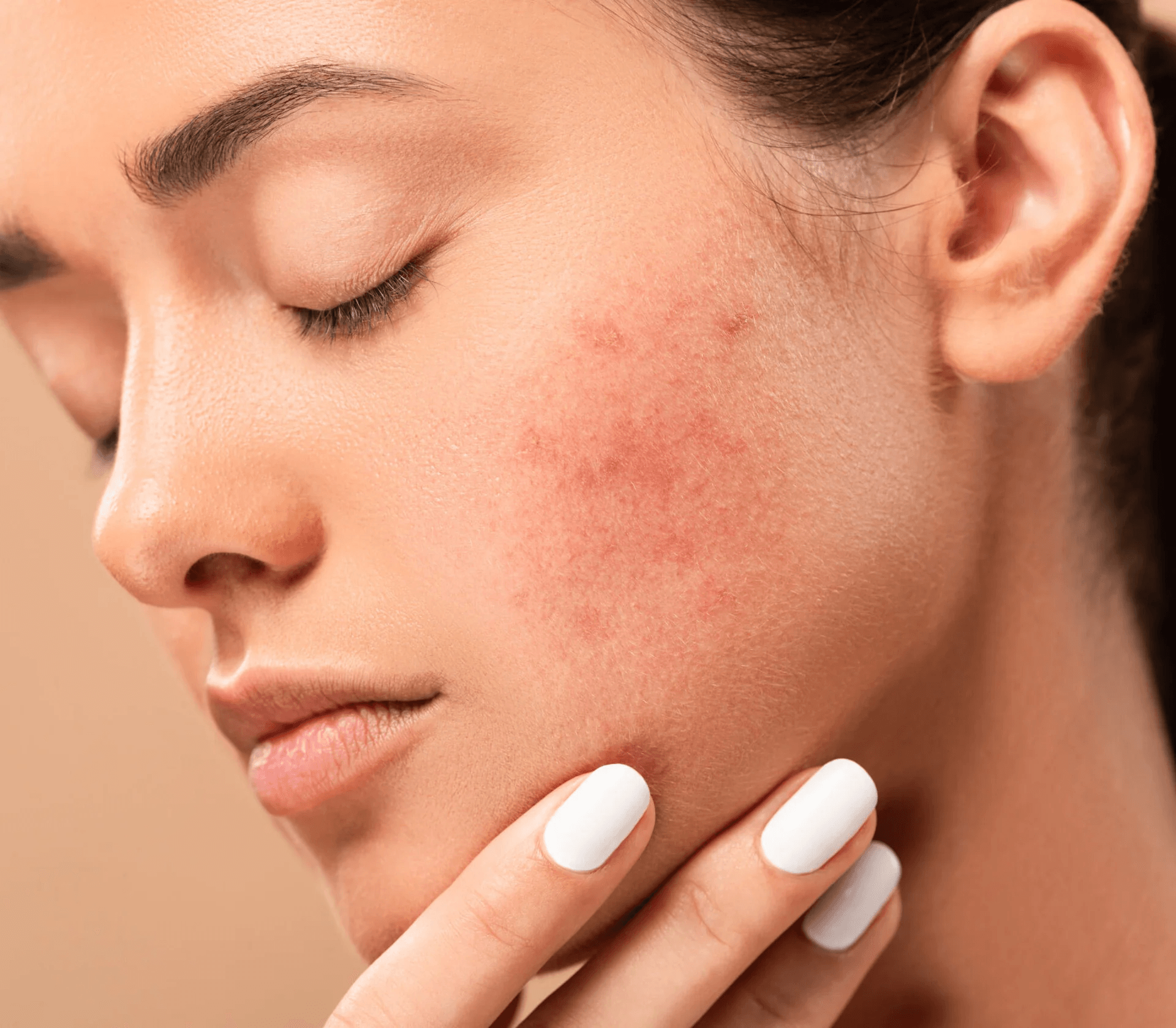 Acne Prone